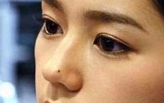 手術(shù)去痣術(shù)后注意事項