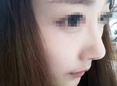 假體<a href=http://www.bolangguoji.com/listinfo-737-0.html target=_blank class=infotextkey>隆鼻</a>鼻頭又腫又硬