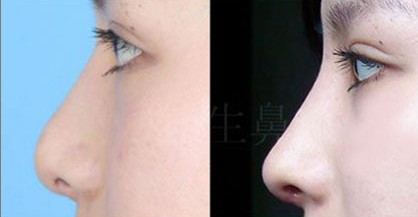 西安<a href=http://www.bolangguoji.com/listinfo-737-0.html target=_blank class=infotextkey>隆鼻</a>價位