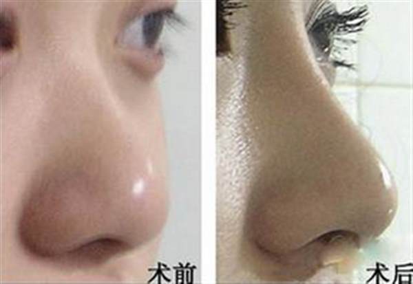 鼻子做完假體幾天消腫