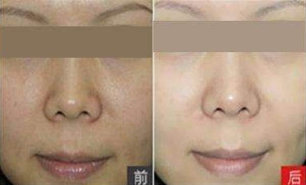 彩光<a href=http://www.bolangguoji.com/listinfo-770-0.html target=_blank class=infotextkey>嫩膚</a>手術效果怎么樣呢