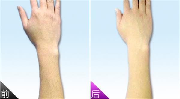 光子<a href=http://www.bolangguoji.com/listinfo-670-0.html target=_blank class=infotextkey>脫毛</a>是否有副反應發生