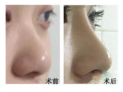 <a href=http://www.bolangguoji.com/listinfo-737-0.html target=_blank class=infotextkey>隆鼻</a>價(jià)位