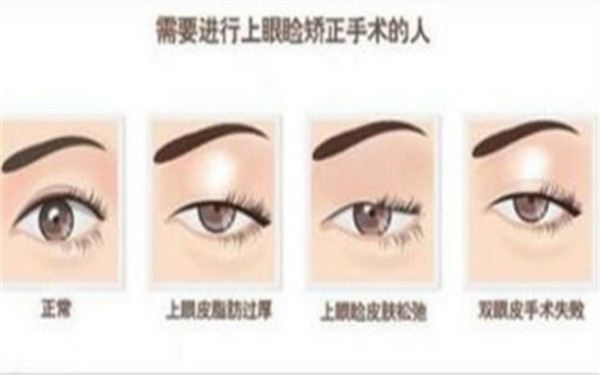上臉下垂的矯正過程