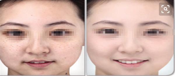什么樣的皮膚問題適合做光子<a href=http://www.bolangguoji.com/listinfo-770-0.html target=_blank class=infotextkey>嫩膚</a>
