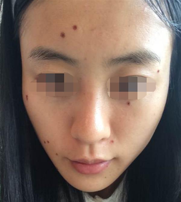 去正規醫院點痣多少錢