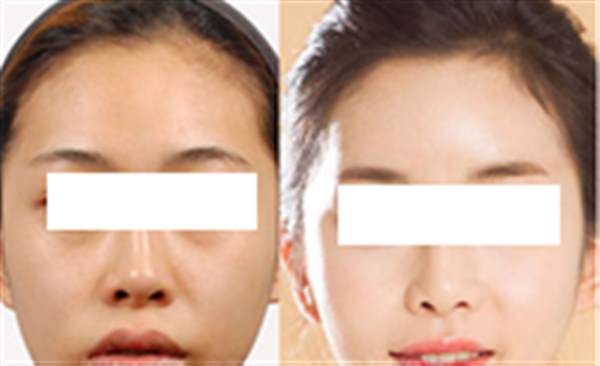盤點光子<a href=http://www.bolangguoji.com/listinfo-770-0.html target=_blank class=infotextkey>嫩膚</a>的危害性