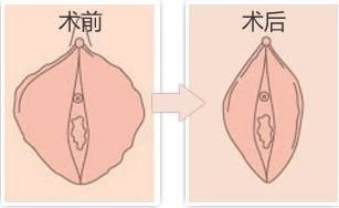 做私密能激光堅持多久