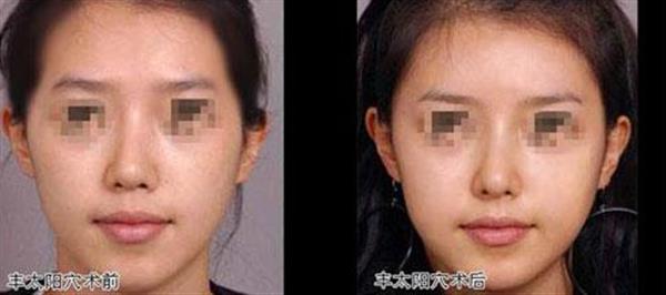 透明質酸<a href=http://www.bolangguoji.com/listinfo-630-0.html target=_blank class=infotextkey>豐太陽穴</a>一般能維持多久