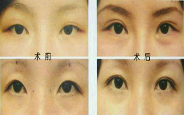 <a href=http://www.bolangguoji.com/listinfo-655-0.html target=_blank class=infotextkey>切眉</a>后多久可以<a href=http://www.bolangguoji.com/listinfo-657-0.html target=_blank class=infotextkey>繡眉</a>?