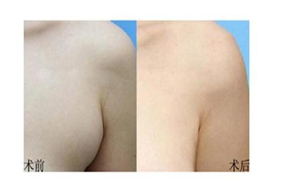 切副乳要多少錢