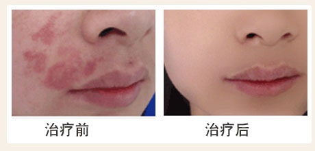 胎記激光后結(jié)痂圖片