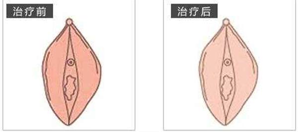 矯正手術(shù)大陰唇危險(xiǎn)嗎