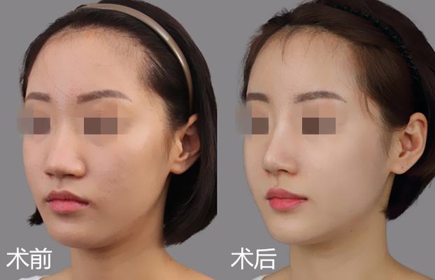 杭州天津做自體軟骨<a href=http://www.bolangguoji.com/listinfo-737-0.html target=_blank class=infotextkey>隆鼻</a>要多少錢