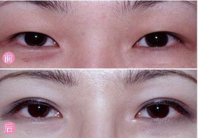 三點<a href=http://www.bolangguoji.com/listinfo-724-0.html target=_blank class=infotextkey>雙眼皮</a>微創手術價格是多少