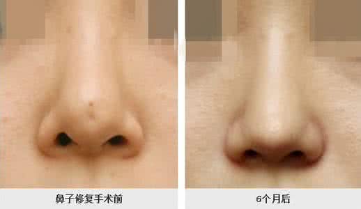 硅膠<a href=http://www.bolangguoji.com/listinfo-737-0.html target=_blank class=infotextkey>隆鼻</a>排異圖片
