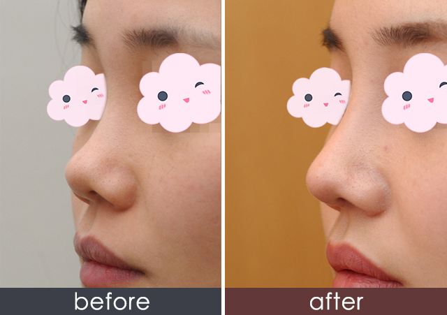 硅膠<a href=http://www.bolangguoji.com/listinfo-737-0.html target=_blank class=infotextkey>隆鼻</a>的壽命