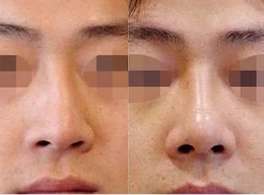 畸形鼻矯正價(jià)格
