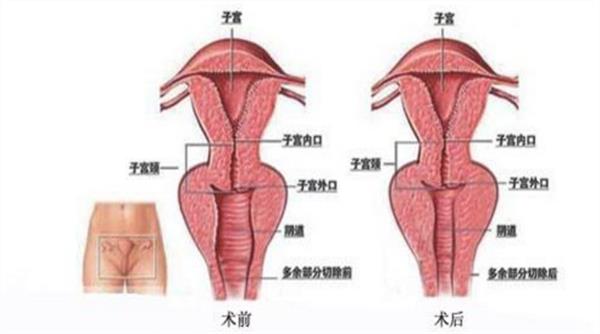 激光縮陰可以保持多久