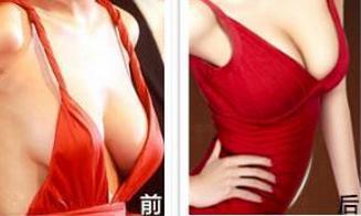 <a href=http://www.bolangguoji.com/listinfo-623-0.html target=_blank class=infotextkey>乳房下垂矯正</a>手術適合人群