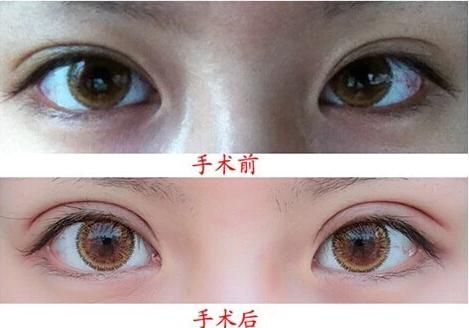 7.5平扇形<a href=http://www.bolangguoji.com/listinfo-724-0.html target=_blank class=infotextkey>雙眼皮</a>效果圖