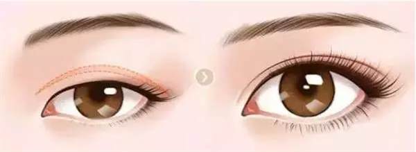 <a href=http://www.bolangguoji.com/listinfo-717-0.html target=_blank class=infotextkey>上瞼下垂矯正</a>原理