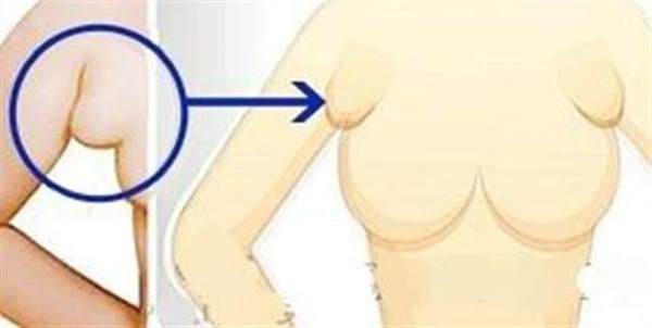 副乳去除多少錢(qián)