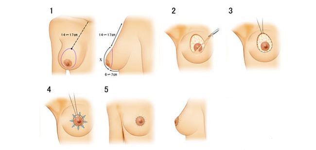 兩側(cè)乳房不對(duì)稱(chēng)是怎么回事