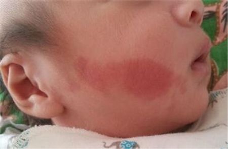 E激光治療鮮紅斑痣需要多少錢(qián)