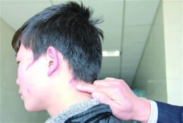 疤痕整容一般多少錢