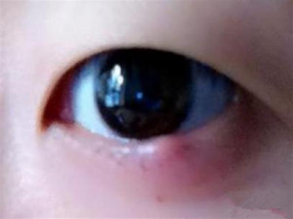 眼睛<a href=http://www.bolangguoji.com/listinfo-722-0.html target=_blank class=infotextkey>臥蠶</a>腫了怎么辦