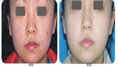 上海激光治療蜘蛛痣價(jià)格是多少