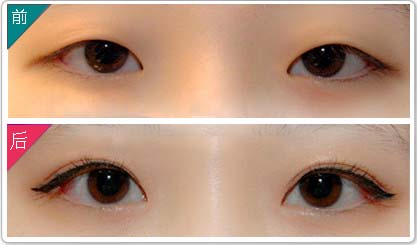成都三點<a href=http://www.bolangguoji.com/listinfo-724-0.html target=_blank class=infotextkey>雙眼皮</a>價格是多少