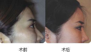 磨顴骨一側(cè)要多少錢