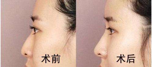 注射<a href=http://www.bolangguoji.com/listinfo-737-0.html target=_blank class=infotextkey>隆鼻</a>術價格