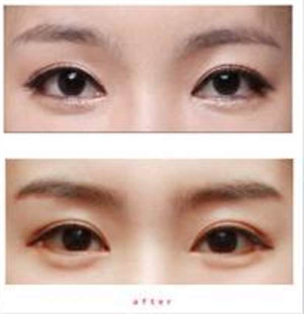 透明質酸豐<a href=http://www.bolangguoji.com/listinfo-722-0.html target=_blank class=infotextkey>臥蠶</a>對會傷害眼角膜嗎