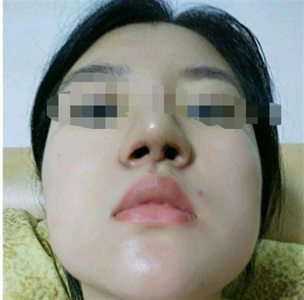 膨體<a href=http://www.bolangguoji.com/listinfo-737-0.html target=_blank class=infotextkey>隆鼻</a>恢復期的圖片