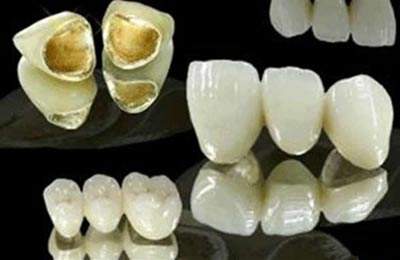 大牙做貴金屬多少錢
