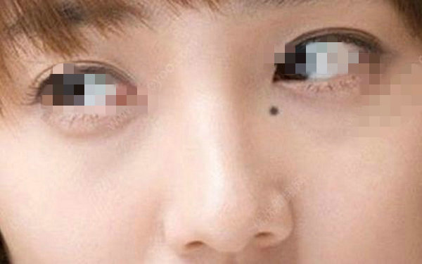 去痣后會留疤痕嗎？
