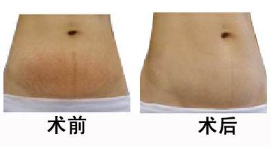 產后的妊娠紋能消除嗎
