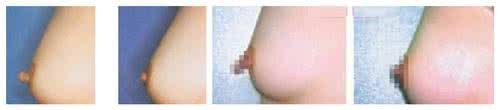 乳頭縮小術多久可以恢復