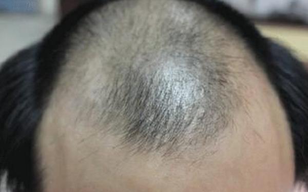 重慶哪家治脫發(fā)醫(yī)院較好