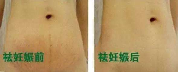 怎樣有效去除妊娠紋