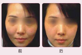 高顴骨整形大概多少錢