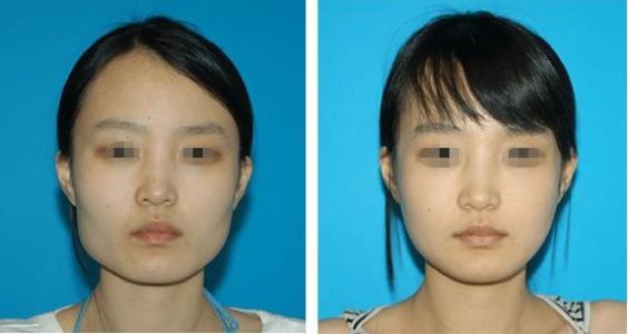 高顴骨如何矯正