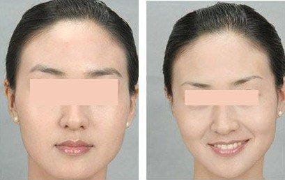 <a href=http://www.bolangguoji.com/listinfo-655-0.html target=_blank class=infotextkey>切眉</a>失敗后遺癥怎么處理