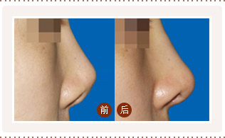 注射<a href=http://www.bolangguoji.com/listinfo-737-0.html target=_blank class=infotextkey>隆鼻</a>整形術價格
