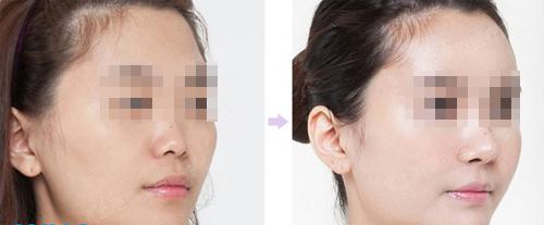 上海注射<a href=http://www.bolangguoji.com/listinfo-737-0.html target=_blank class=infotextkey>隆鼻</a>子需要多少錢