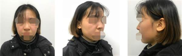 韓式<a href=http://www.bolangguoji.com/listinfo-737-0.html target=_blank class=infotextkey>隆鼻</a>前后對比照片案例