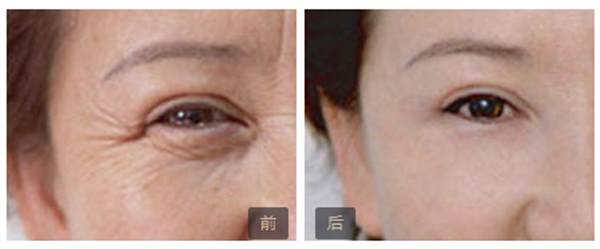 肉毒祛皺多少錢